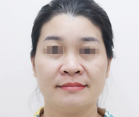 Mũi lót sụn – Cắt cánh mũi – Cắt xương