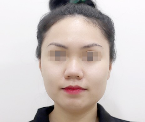 Mũi lót sụn – Cắt cánh mũi – Thu chóp – Cà gồ