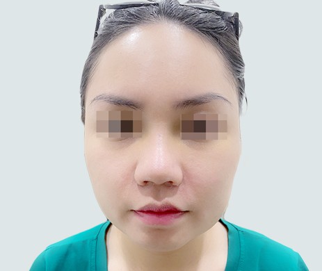 Mũi lót sụn – Cắt cánh mũi – Thu chóp – Cà gồ