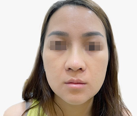 Mũi lót sụn – Cắt cánh mũi – Thu chóp – Độn cằm