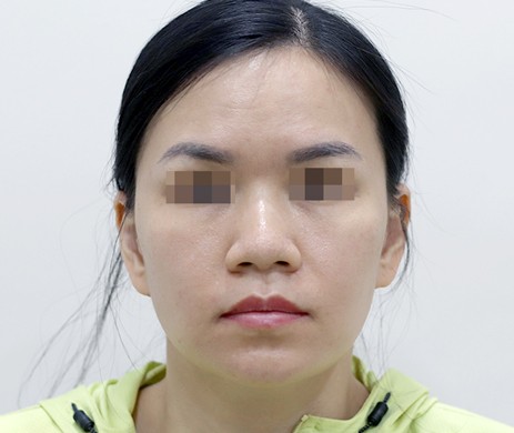 Mũi nhân tạo – Cà gồ