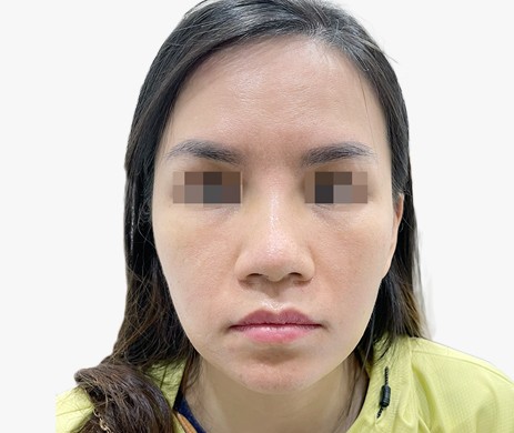 Mũi nhân tạo – Cà gồ