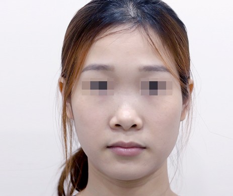 Mũi lót sụn – Thu chóp