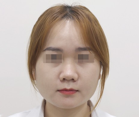 Mũi lót sụn – Thu chóp