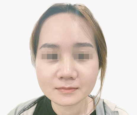 Mũi lót sụn – Thu chóp