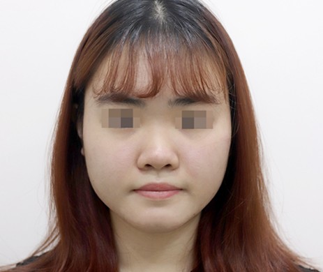 Mũi lót sụn – Thu chóp