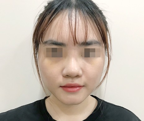 Mũi lót sụn – Thu chóp