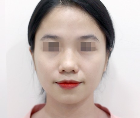 Mũi lót sụn – Thu chóp – Cà gồ