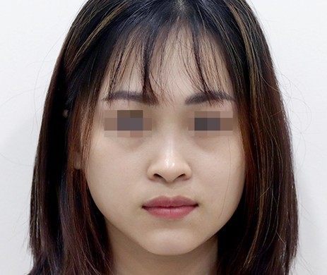 Mũi lót sụn – Thu chóp