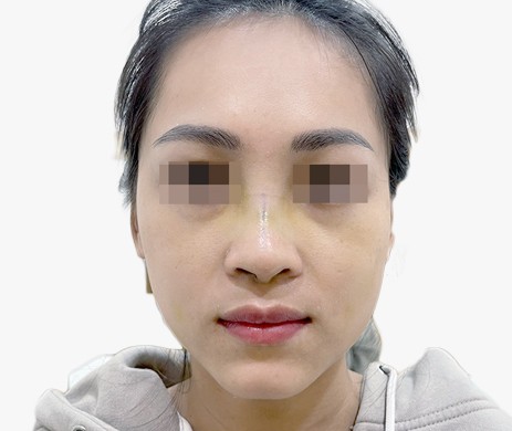 Mũi lót sụn – Thu chóp