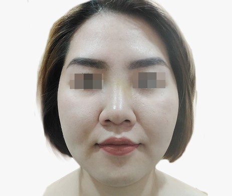 Mũi lót sụn – Cắt xương