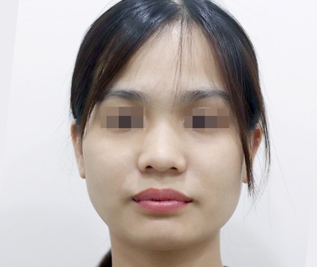 Mũi lót sụn – Cắt cánh mũi – Thu chóp