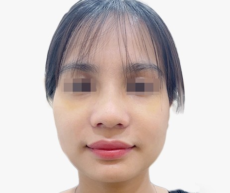 Mũi lót sụn – Cắt cánh mũi – Thu chóp