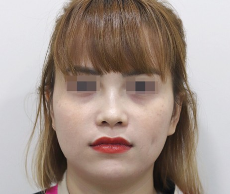 Mũi lót sụn – Cắt xương