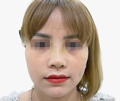 Mũi lót sụn – Cắt xương