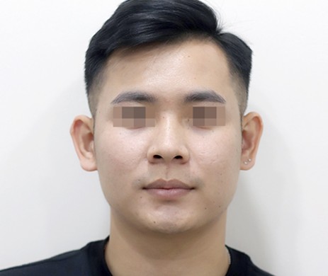 Mũi nhân tạo – Cắt cánh mũi nam