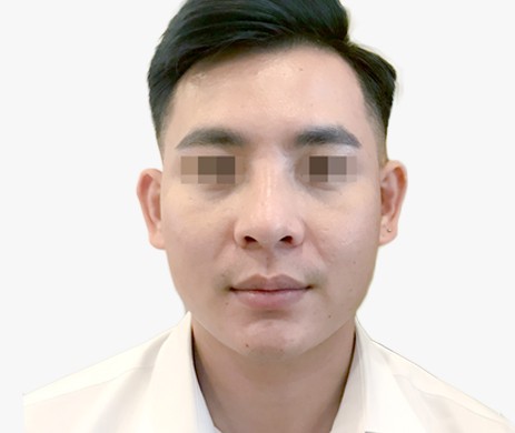 Mũi nhân tạo – Cắt cánh mũi nam