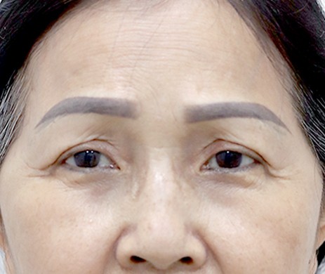 Treo cung mày – Cắt mí trên