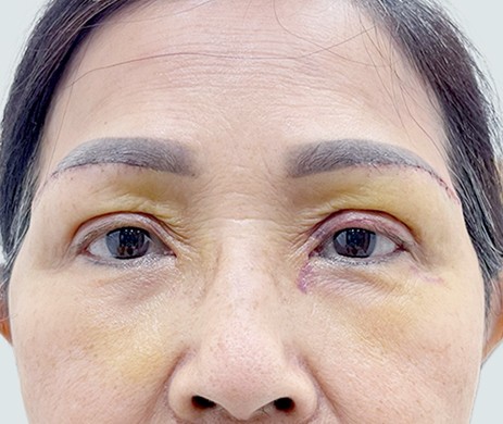 Treo cung mày – Cắt mí trên