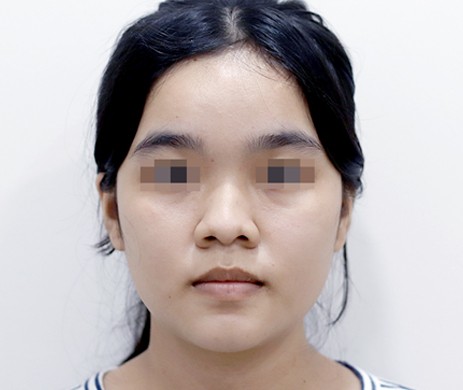 Mũi nhân tạo – Cắt cánh