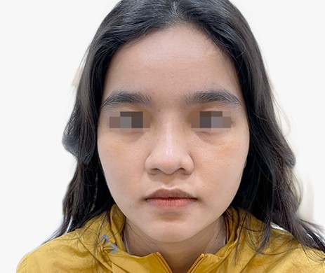 Mũi nhân tạo – Cắt cánh