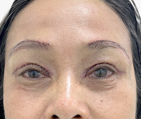 Treo cung mày – Cắt mí trên