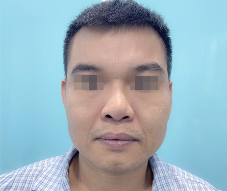 Mũi cấu trúc sụn sườn sửa lại và Độn cằm nam 12 ngày