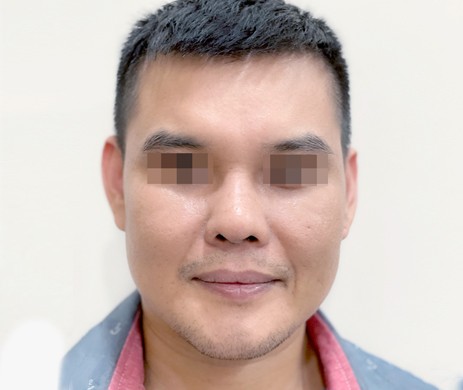 Mũi cấu trúc sụn sườn sửa lại và Độn cằm nam 12 ngày