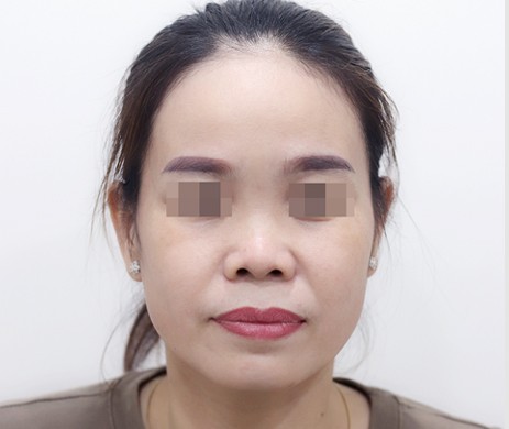 Mũi lót sụn – Cắt cánh