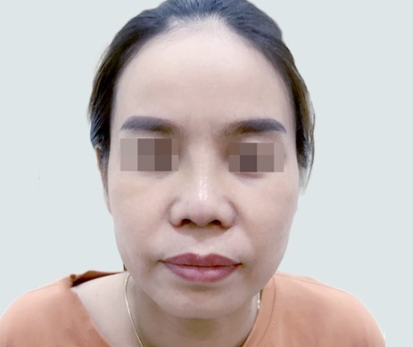 Mũi lót sụn – Cắt cánh