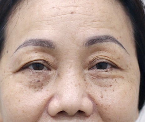 Treo cung mày – Cấy mỡ mí dưới