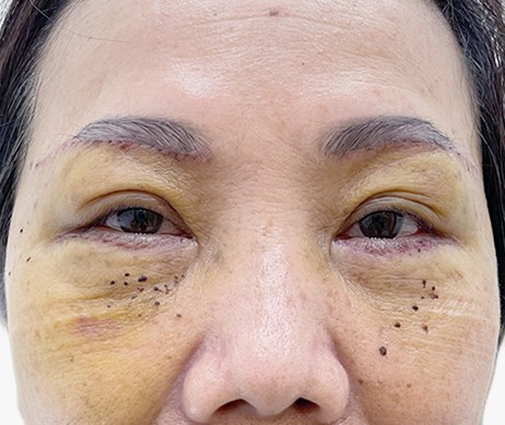 Treo cung mày – Cấy mỡ mí dưới