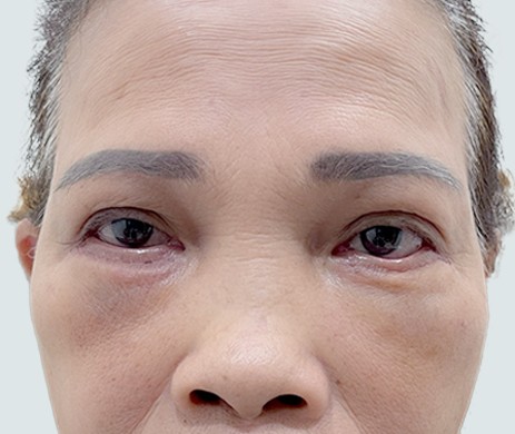 Cắt mí trên – Cấy mỡ mí dưới