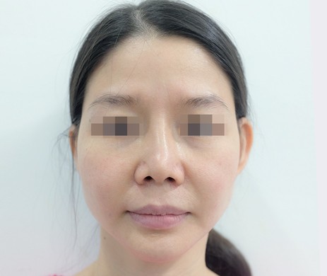 Mũi cấu trúc sụn sườn sửa lại – Cắt xương – Cắt cánh cánh mũi