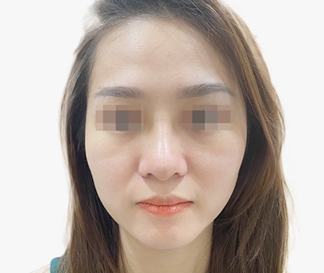 Mũi lót sụn – Cắt cánh