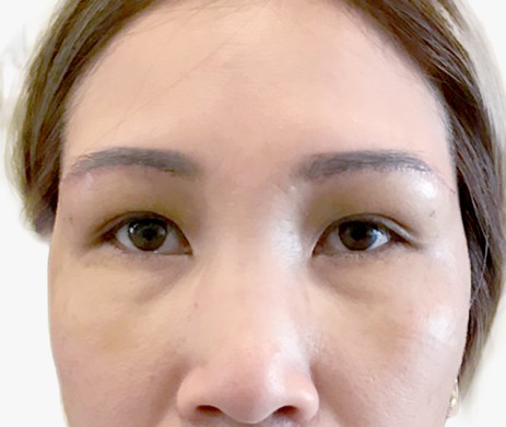 Treo cung mày – Cấy mỡ mí trên