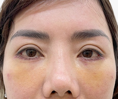 Cắt mí dưới – Cấy mỡ mí dưới