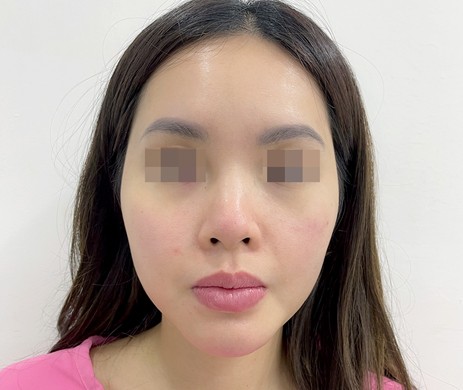 Mũi cấu trúc sụn sườn sửa lại