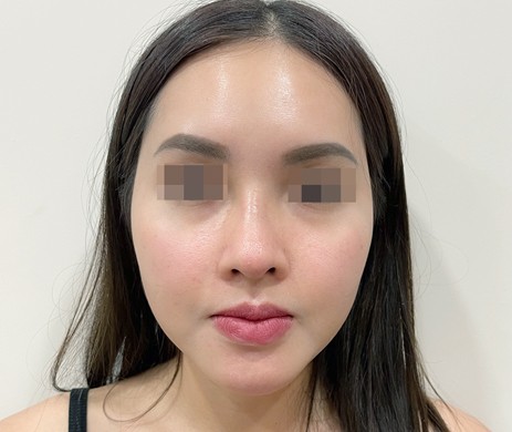 Mũi cấu trúc sụn sườn sửa lại