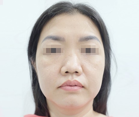 Mũi cấu trúc sụn sườn sửa lại – Cắt xương mũi – Cắt cánh mũi