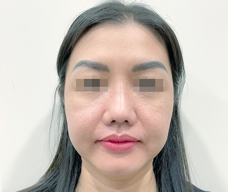 Mũi cấu trúc sụn sườn sửa lại – Cắt xương mũi – Cắt cánh mũi