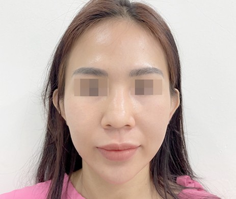 Mũi cấu trúc sụn sườn – Cắt xương – Cắt cánh mũi