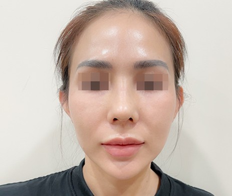 Mũi cấu trúc sụn sườn – Cắt xương – Cắt cánh mũi