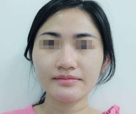 Mũi lót sụn – Cắt xương – Cà gồ