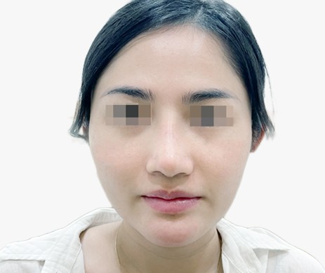 Mũi lót sụn – Cắt xương – Cà gồ