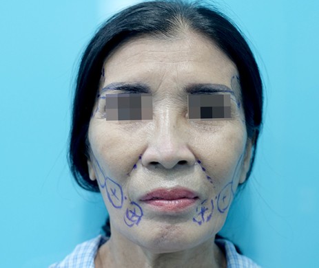 Cấy mỡ má + thái dương + rãnh cười