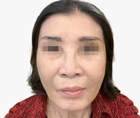 Cấy mỡ má + thái dương + rãnh cười