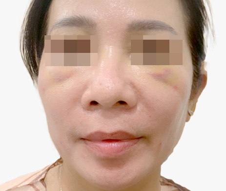 Cấy mỡ rãnh cười