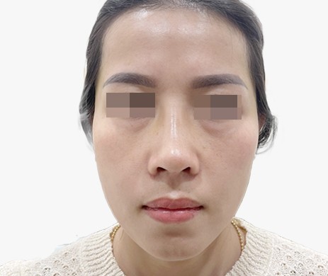 Cấy mỡ thái dương