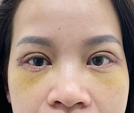 Cắt mí trên – mí dưới